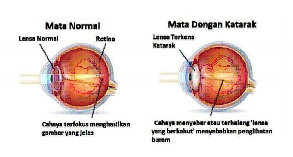 Katarak Rumah Sakit Mata Jec